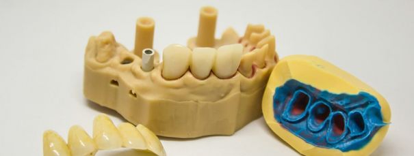 Имплантация зубов: современные решения