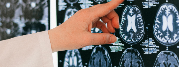 Neirogrāfija un elektromiogrāfija – precīzas un drošas nervu un muskuļu izmeklēšanas metodes